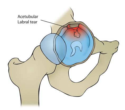 how can one heal a hip labral tear